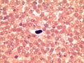 Blood smear of a patient with malaria Plasmodium falciparum Royalty Free Stock Photo