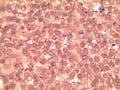 Blood smear of a patient with malaria Plasmodium falciparum - under the microscope Royalty Free Stock Photo