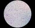 Blood smear showing abnormal high volume of platelet and White Blood Cell analyze by microscope, Essential thrombocytosis