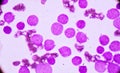 Blood smear under microscopy showing on Adult acute myeloid leukemia AML is a type of cancer in which the bone marrow makes abn Royalty Free Stock Photo