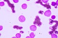 Blood smear under microscopy showing on Adult acute myeloid leukemia AML is a type of cancer in which the bone marrow makes abn Royalty Free Stock Photo