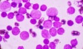 Blood smear under microscopy showing on Adult acute myeloid leukemia AML is a type of cancer in which the bone marrow makes abn Royalty Free Stock Photo