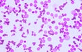 Blood smear under microscopy showing on Adult acute myeloid leukemia AML is a type of cancer in which the bone marrow makes abn Royalty Free Stock Photo