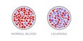 Blood test comparison: normal and leukemia
