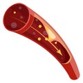 Blood trombosis formation. Atherosclerosis artery medical illustration