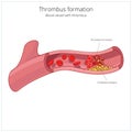 Blood vessel and clot thrombus vector illustration