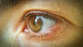 Blood vessel on the eyeball. Intraocular pressure. Bloodshot eyes. Close-up macro photography. Bleeding damage to the eye