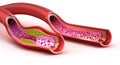 Blood vessel : normal and cholesterol damaged vessel Royalty Free Stock Photo