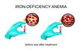 Blood in vitro. red blood cells for iron deficiency anemia