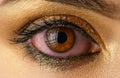 Bloodshot eye - conjunctivitis or allergic reaction