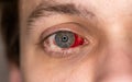 Bloodshot human eye with noticeable subconjunctival hemorrhage. Blood in eyeball, close up