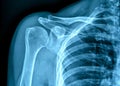 X-ray film of human shoulder Royalty Free Stock Photo