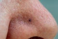 Blue nevus on senior womans nose. Close up. Royalty Free Stock Photo