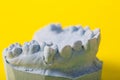 Blue plaster model of an impression of a patient's jaw at an orthodontist dentist on a yellow background Royalty Free Stock Photo