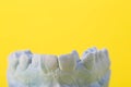Blue plaster model of an impression of a patient's jaw at an orthodontist dentist on a yellow background Royalty Free Stock Photo
