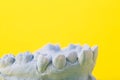 Blue plaster model of an impression of a patient's jaw at an orthodontist dentist on a yellow background Royalty Free Stock Photo