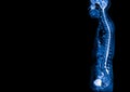 MRI of human spine in sagittal or lateral view.Diagnosis of spine metastasis with back pain. Royalty Free Stock Photo