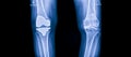 Blue tone of xray image in orthopedic unit inside hospital on black background.X-Ray for diagnosis of knee pain patient. Royalty Free Stock Photo