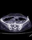 CT Scan lower abdomen Severe hydronephrosis Rt kidney with distal ureteric obstruction, may due to infiltrative tumor at Rt