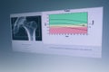 BMD Woman hip joint bone mass image The graph has a standard point below Therefore diagnosed with osteoporosis