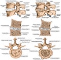 BOARD Advanced uncovertebral arthrosis Royalty Free Stock Photo