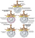 BOARD Nerves, stages of lumbar disc herniation Royalty Free Stock Photo