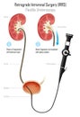 Retrograde Intrarenal Surgery, RIRS Royalty Free Stock Photo