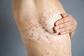 Body Skin With Psoriasis Autoimmune Disease