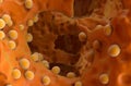 Bone cancer osteosarcoma - closeup view 3d illustration