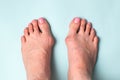 Bone on the foot. Hallux valgus disease Royalty Free Stock Photo