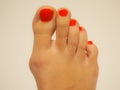 hallux valgus, painful bent big toe,