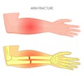 Bone fracture_Hand fracture