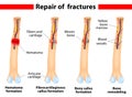 Bone fracture healing process Royalty Free Stock Photo