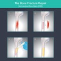 The Bone Fracture Repair.