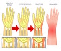 Bone fracture_Wrist fracture osteoporosis