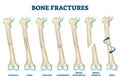 Bone fractures vector illustration. Labeled various broken leg or arm scheme Royalty Free Stock Photo