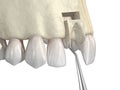 Bone grafting- augmentation using block of bone, tooth implantation. Medically accurate 3D illustration