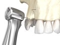 Bone grafting- augmentation using block of bone, tooth implantation. Medically accurate 3D illustration