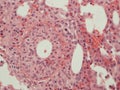 Bone marrow granulomatosis in acute Q fever.