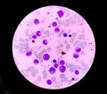 Bone marrow study: Dimorphic Erythroid hyperplasia