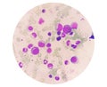 Bone marrow study: Suggestive of reactive marrow with dimorphic Erythroid hyperplasia