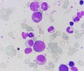 Bone marrow study: dimorphic Erythroid hyperplasia