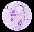 Bone marrow study: Suggestive of reactive marrow with dimorphic Erythroid hyperplasia