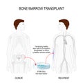 Bone marrow transplantation Royalty Free Stock Photo