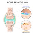 Bone remodeling. Cross section of joint. Close-up of Osteoblasts that Synthesize bone tissue, and Osteoclast removes bone tissue Royalty Free Stock Photo