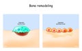 Bone remodeling. Osteoclast resorbs bone, and Osteoblasts synthesized bone tissue.