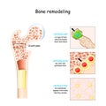 Bone remodeling process. Osteoblast, osteoclast, and osteocyte Royalty Free Stock Photo