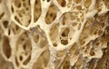 Bone structure in osteoporosis. vitamin D deficiency, fractures, estrogen