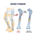 Bone tumor as abdominal tissue growth on human skeleton outline diagram Royalty Free Stock Photo