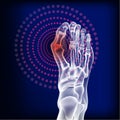 Bones the of foot with Rheumatoid arthritis